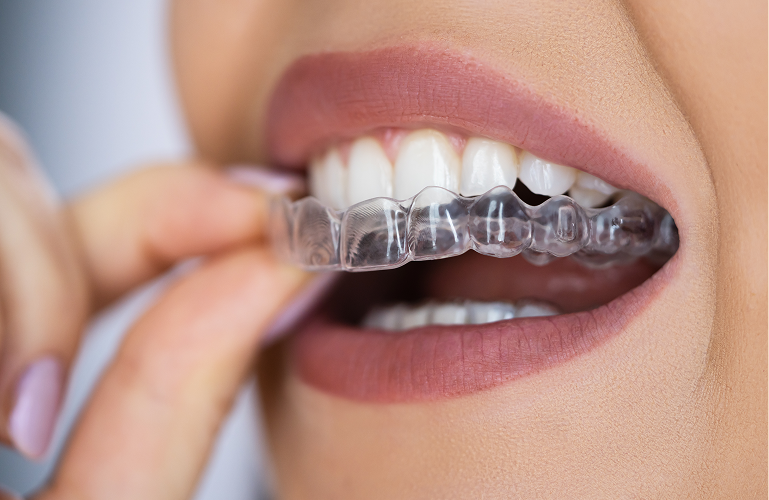 Essix Retainers