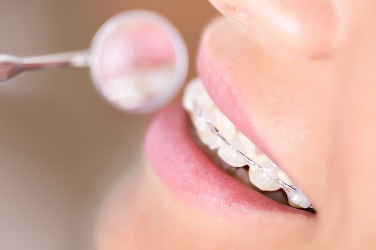 Close Up Of Orthodontist Examining Patient Wearing Braces