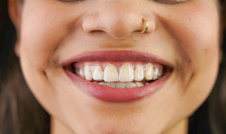 Close Up Of Smiling Girl Wearing Clear Aligners
