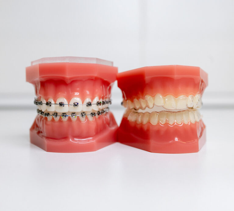 Two hard plastic dental models, one with braces and one with clear aligners