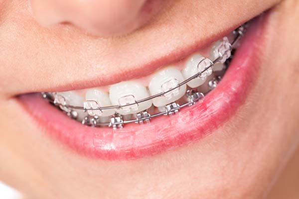How To Care For Ceramic Braces