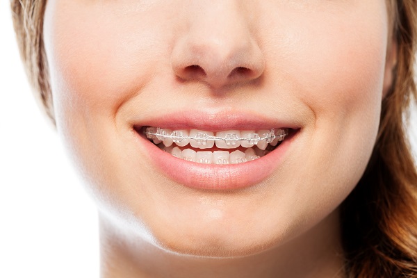 Why Clear Braces For Teens Are Recommended