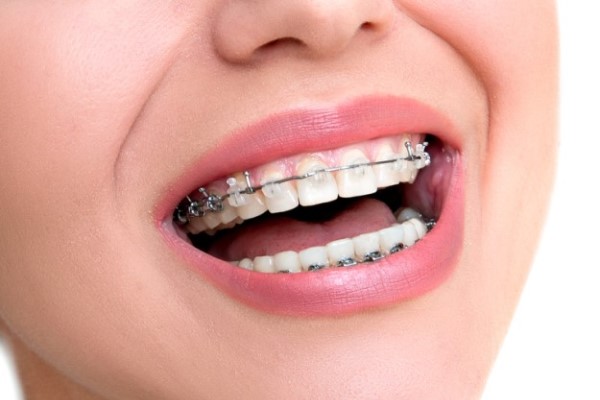 Orthodontist Near Me: Your Path To A Confident Smile